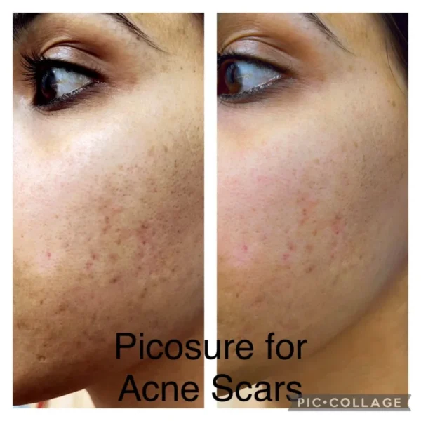 Picosure Before and After in Fountain Valley, CA by LadyBelle Med Spa