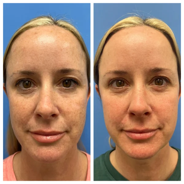 Picosure Before and After in Fountain Valley, CA by LadyBelle Med Spa