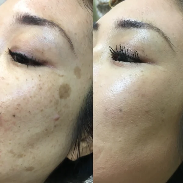 Picosure Before and After in Fountain Valley, CA by LadyBelle Med Spa
