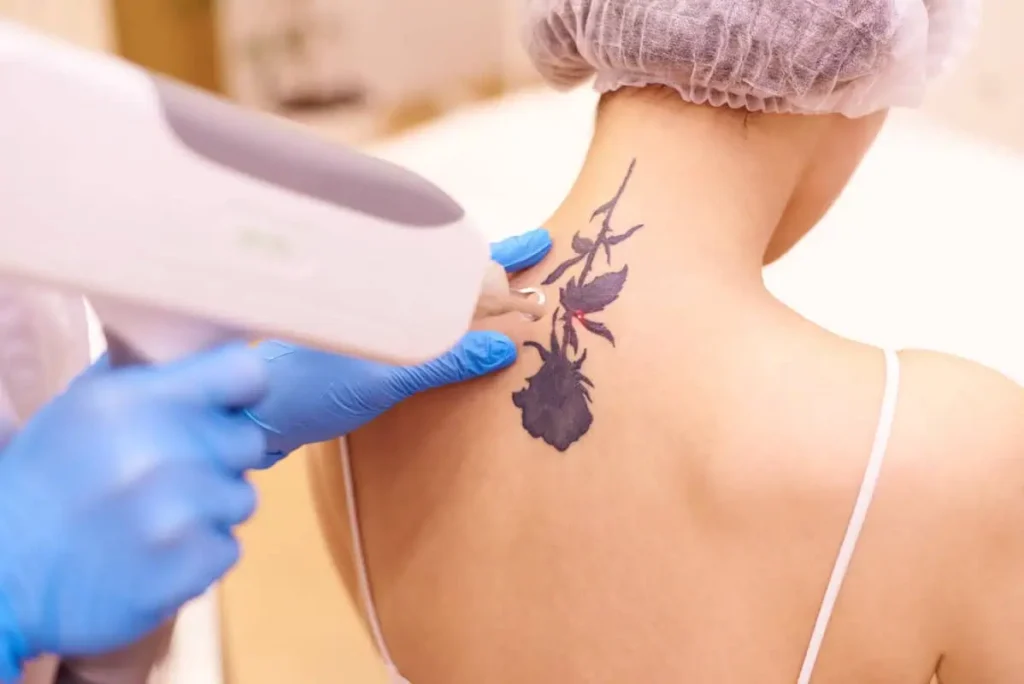 Laser Tattoo Removal in Fountain Valley, CA at LadyBelle Medspa