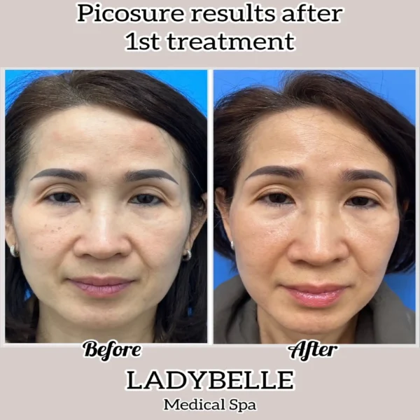 Picosure-3-ladybelle-medspa-in-fountain-valley-ca