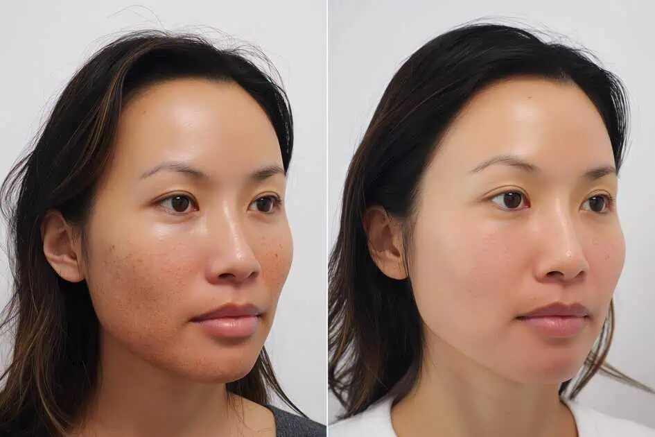 Dark Spot Removal In Fountain Valley, CA by LadyBelle, Inc