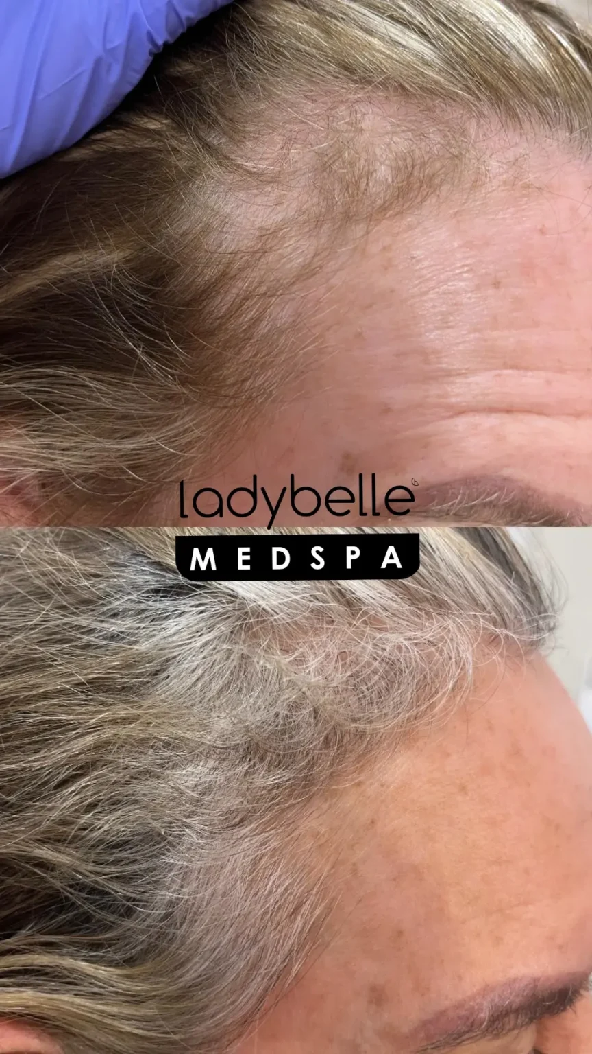 Hair restoration treatment progress at LadyBelle Med Spa