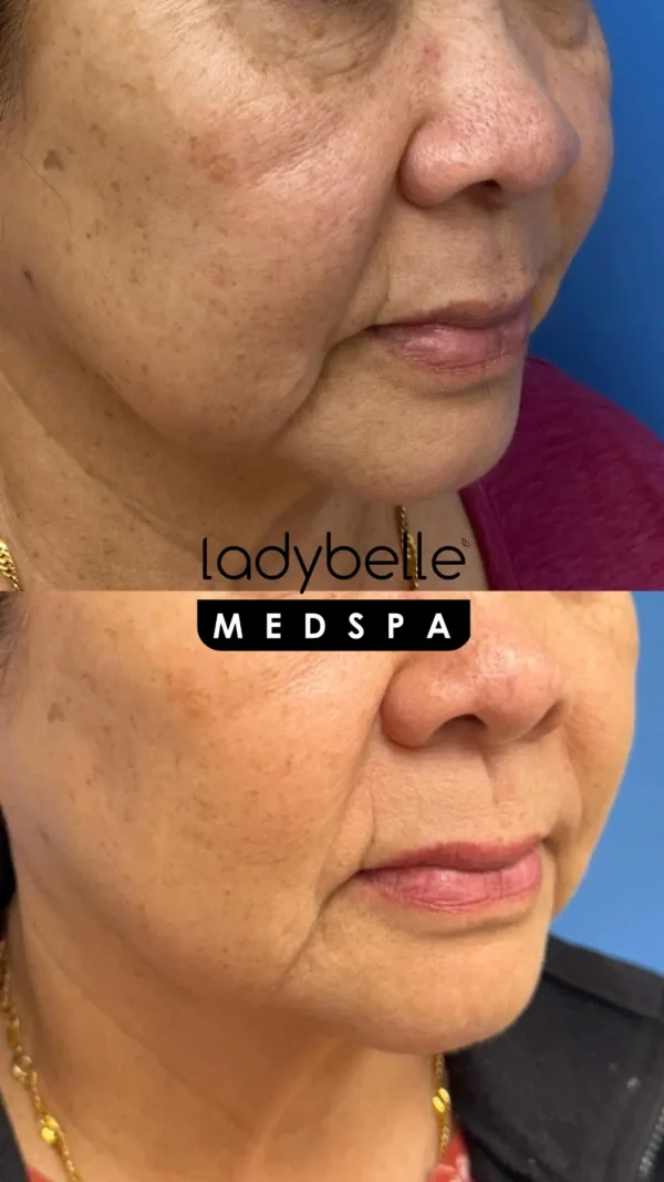 Before and after chin and jawline treatment at LadyBelle Med Spa in Fountain Valley, CA