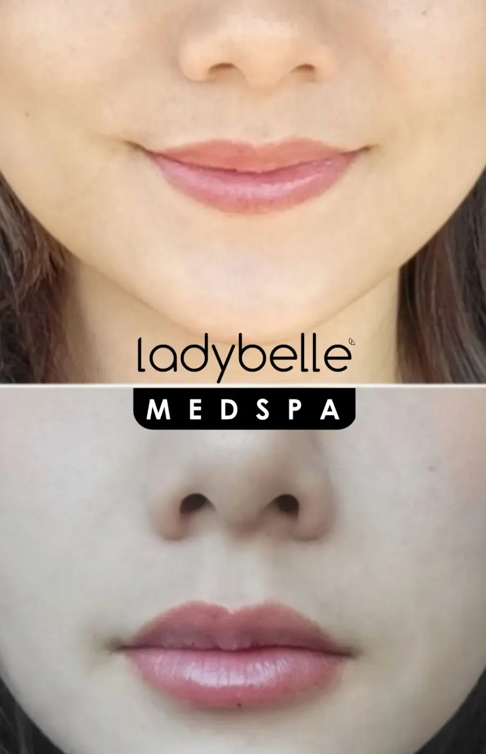 Before and after lip enhancement at LadyBelle Med Spa
