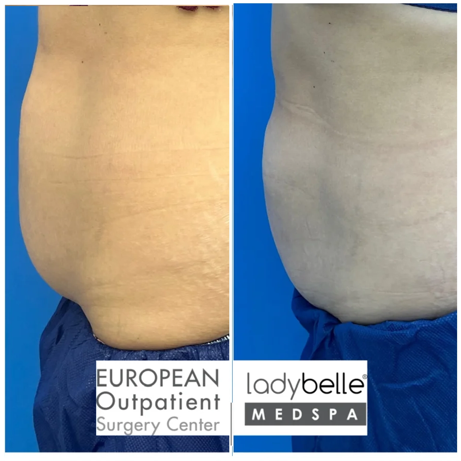 coolsculpting-before-after