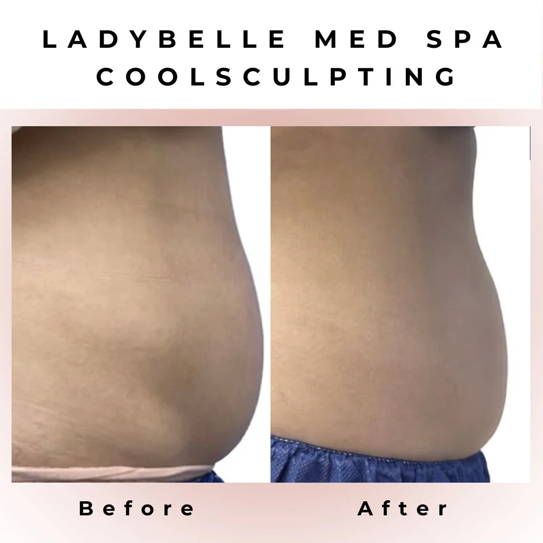 ladybella CoolSculpting