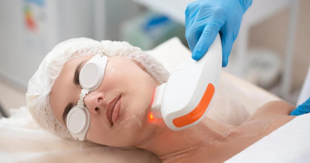 A woman wearing goggles receiving laser skin resurfacing on her chin and neck in Fountain Valley, CA.