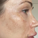 Dark Spots Removal Before & After Patient #429