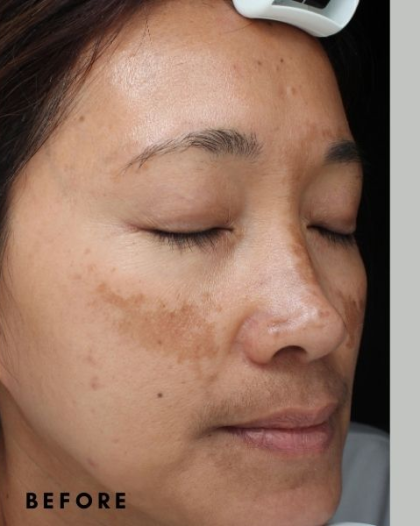 Dark Spots Removal Before & After Patient #430