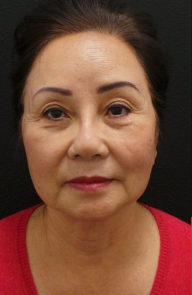 Ultherapy Before & After Patient #435