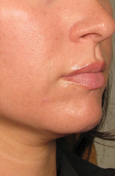 Ultherapy Before & After Patient #437