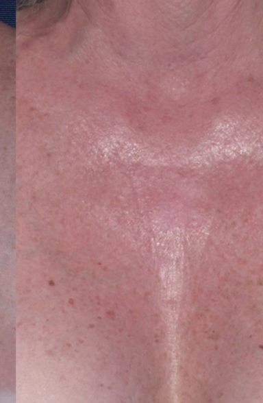 Ultherapy Before & After Patient #438