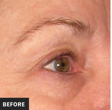 Ultherapy Before & After Patient #439