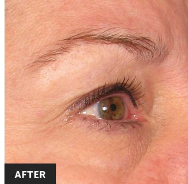 Ultherapy Before & After Patient #439