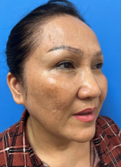 Picosure Laser Before & After Patient #546