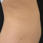 CoolSculpting Before & After Patient #705