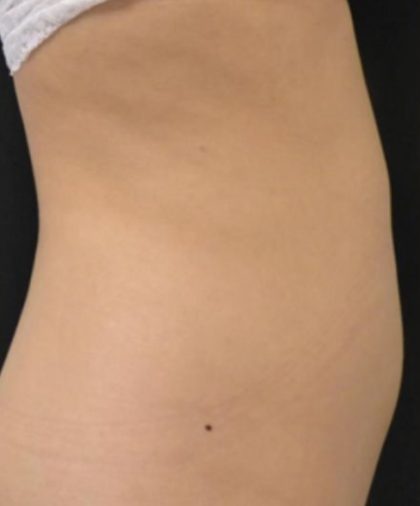 CoolSculpting Before & After Patient #705
