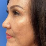 Ultherapy Before & After Patient #738