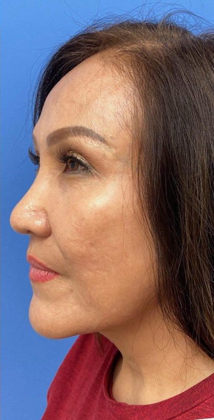 Ultherapy Before & After Patient #738