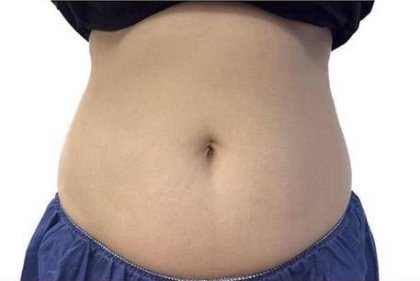 CoolSculpting Before & After Patient #769